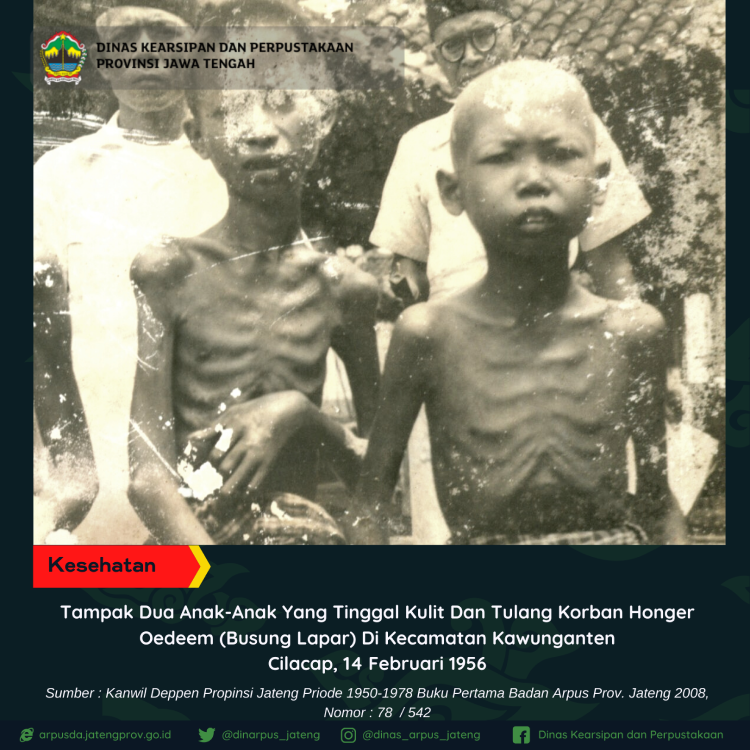 Dua Anak Yang Tinggal Kulit Dan Tulang Korban Honger Oedeem (Busung Lapar)